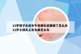 12岁孩子头皮长牛皮癣头皮都破了怎么办 12岁小孩头上长头癣怎么办