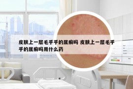 皮肤上一层毛乎乎的属癣吗 皮肤上一层毛乎乎的属癣吗用什么药