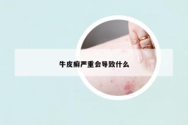 牛皮癣严重会导致什么