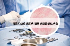 阴囊灼烧感银屑病 银屑病阴囊部位病变