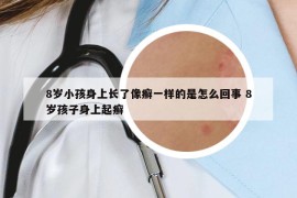 8岁小孩身上长了像癣一样的是怎么回事 8岁孩子身上起癣