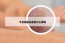 牛皮癣起白屑是什么原理