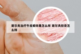 萌尔夫治疗牛皮癣效果怎么样 萌尔夫软膏怎么样