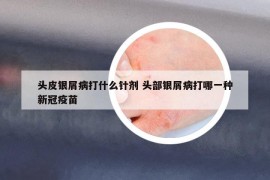 头皮银屑病打什么针剂 头部银屑病打哪一种新冠疫苗