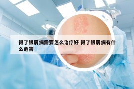 得了银屑病需要怎么治疗好 得了银屑病有什么危害