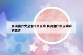 民间偏方大全治疗牛皮癣 民间治疗牛皮病癣的偏方