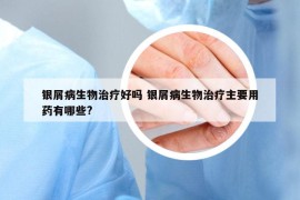 银屑病生物治疗好吗 银屑病生物治疗主要用药有哪些?