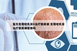 复方克霉唑乳膏II治疗银屑病 克霉唑乳膏治疗银屑病管用吗