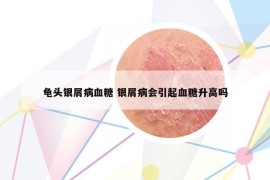 龟头银屑病血糖 银屑病会引起血糖升高吗