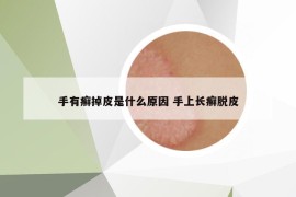 手有癣掉皮是什么原因 手上长癣脱皮