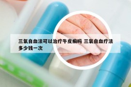 三氧自血法可以治疗牛皮癣吗 三氧自血疗法多少钱一次