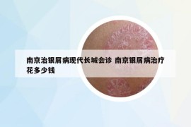 南京治银屑病现代长城会诊 南京银屑病治疗花多少钱