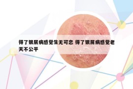 得了银屑病感觉生无可恋 得了银屑病感觉老天不公平