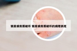 银屑病骨质破坏 银屑病骨质破坏的病理表现