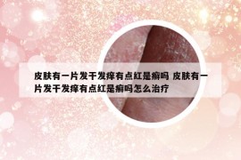 皮肤有一片发干发痒有点红是癣吗 皮肤有一片发干发痒有点红是癣吗怎么治疗