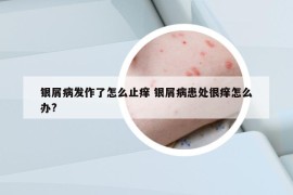 银屑病发作了怎么止痒 银屑病患处很痒怎么办?