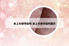 身上长癣传染吗 身上长癣传染吗图片