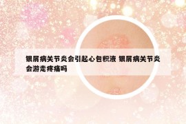 银屑病关节炎会引起心包积液 银屑病关节炎会游走疼痛吗