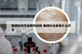 胳膊肘的牛皮癣特顽固 胳膊肘皮癣用什么药膏