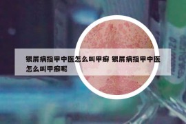 银屑病指甲中医怎么叫甲癣 银屑病指甲中医怎么叫甲癣呢