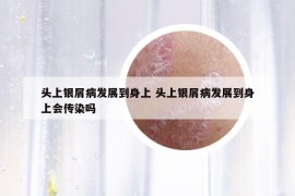 头上银屑病发展到身上 头上银屑病发展到身上会传染吗