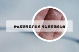 什么原因导致的头癣 什么原因引起头癣