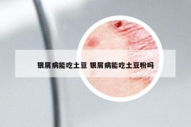 银屑病能吃土豆 银屑病能吃土豆粉吗