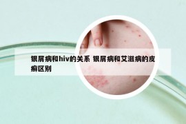 银屑病和hiv的关系 银屑病和艾滋病的皮癣区别