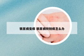 银屑病变痒 银屑病特别痒怎么办