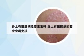 身上有银屑病能要宝宝吗 身上有银屑病能要宝宝吗女孩