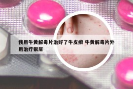 我用牛黄解毒片治好了牛皮癣 牛黄解毒片外用治疗银屑