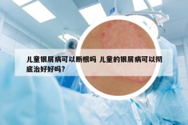 儿童银屑病可以断根吗 儿童的银屑病可以彻底治好好吗?