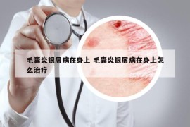 毛囊炎银屑病在身上 毛囊炎银屑病在身上怎么治疗