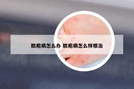 脓疱病怎么办 脓疱病怎么样根治