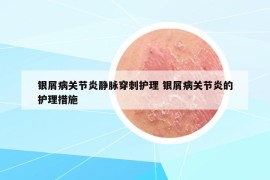 银屑病关节炎静脉穿刺护理 银屑病关节炎的护理措施