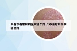 长春市看银屑病医院哪个好 长春治疗银屑病哪里好