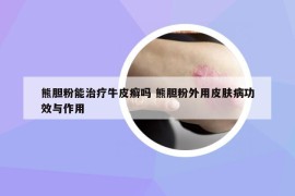 熊胆粉能治疗牛皮癣吗 熊胆粉外用皮肤病功效与作用