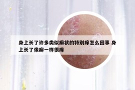 身上长了许多类似癣状的特别痒怎么回事 身上长了像癣一样很痒