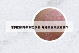 来例假前牛皮癣总反复 月经前皮炎反复发作