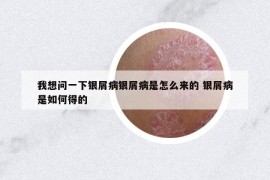 我想问一下银屑病银屑病是怎么来的 银屑病是如何得的