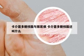 卡介菌多糖核酸与银屑病 卡介菌多糖核酸还叫什么