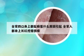 全家四口身上都起癣是什么原因引起 全家人都身上长红疙瘩很痒