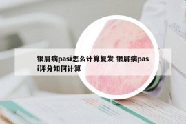 银屑病pasi怎么计算复发 银屑病pasi评分如何计算