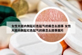 女性大腿内侧起红色起气的癣怎么回事 女性大腿内侧起红色起气的癣怎么回事图片