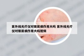 紫外线光疗仪对银屑病作用大吗 紫外线光疗仪对银屑病作用大吗视频