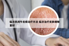 临沂民间牛皮癣治疗方法 临沂治疗皮肤病哪里好