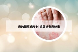 唐炜银屑病专利 银屑病专利秘密