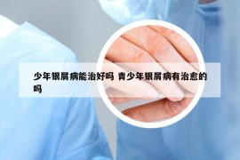 少年银屑病能治好吗 青少年银屑病有治愈的吗