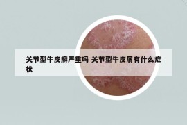 关节型牛皮癣严重吗 关节型牛皮屑有什么症状