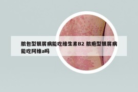 脓包型银屑病能吃维生素B2 脓疱型银屑病能吃阿维a吗